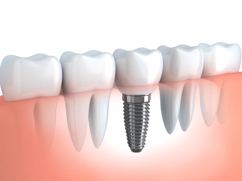 Dental Implants  West Hills, CA 